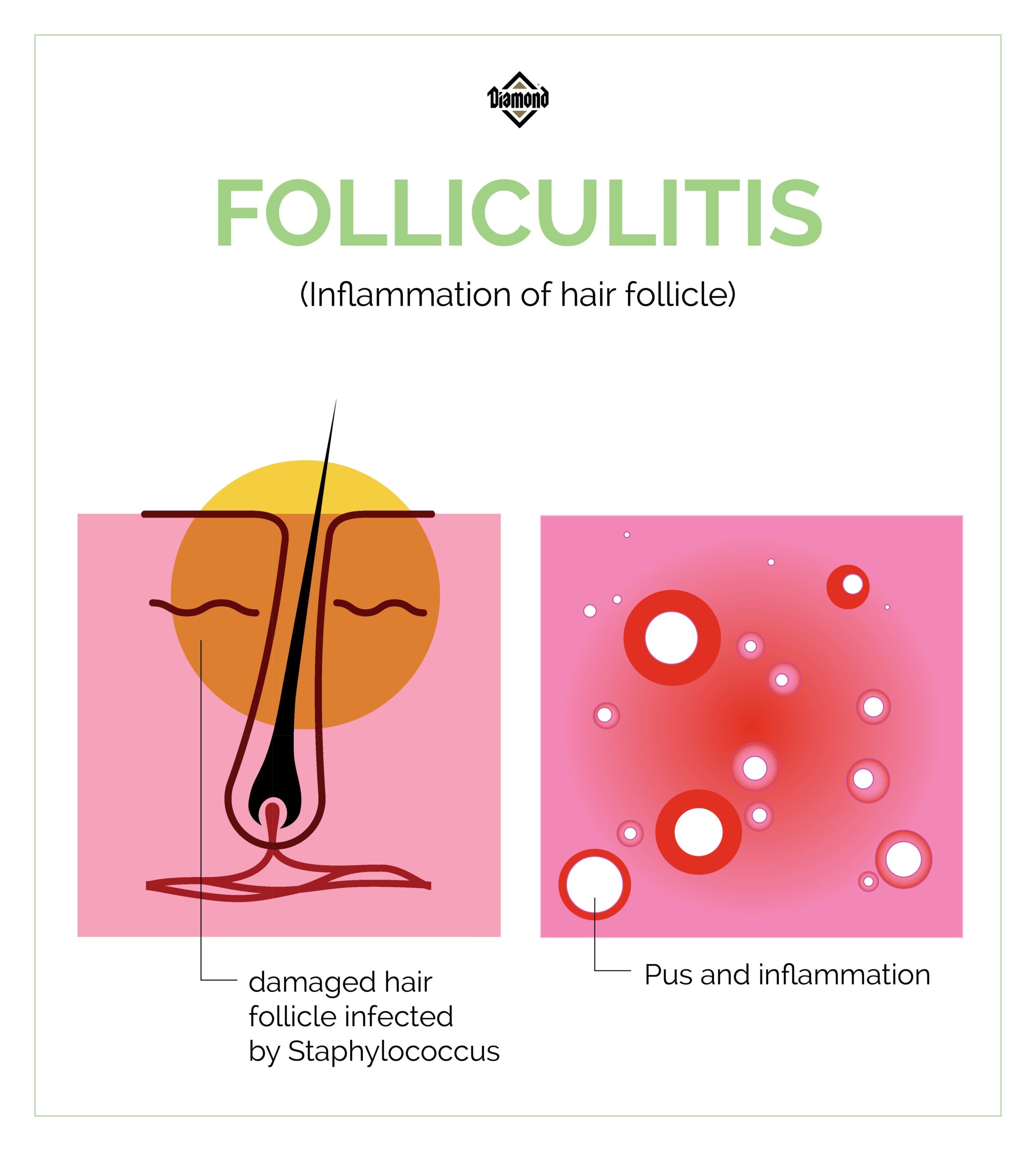 An interior graphic depicting what folliculitis is and how a damaged hair follicle causes inflammation.